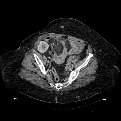 Incarcerated Inguinal Hernia With Perforation Radiology Case