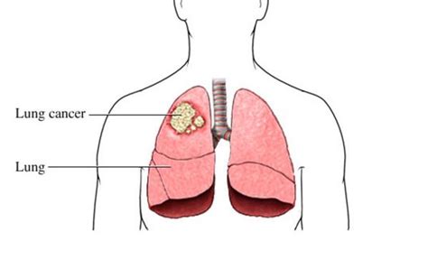 These changes are the result of the interaction between a person's genetic factors and three categories of. Do You Know These 14 Lung Cancer Symptoms? | SeeReadShare