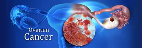 Ovarian Cancer Tumor Marker Ovarian Cancer Tumor Markers Markerii
