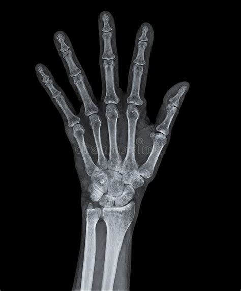 Esqueleto Da Mão Foto De Stock Imagem De Cuidado Imagem 94157148