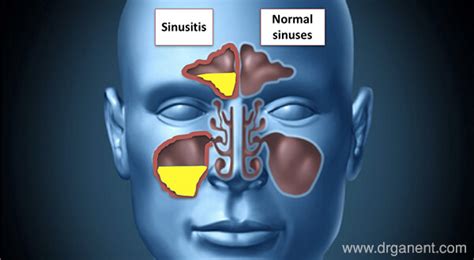 Sinus And Sinusitis Dr Gan Ent