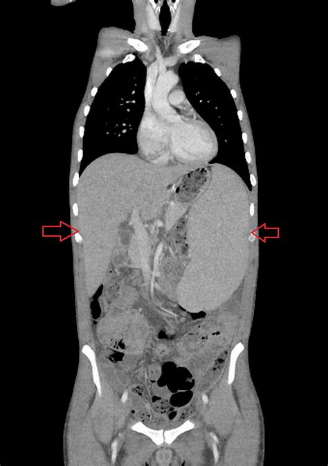 Cureus Adult Onset Primary Hemophagocytic Lymphohistiocytosis