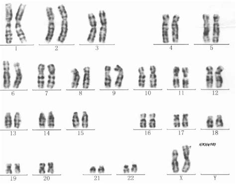 Figure 3 From Duchenne Muscular Dystrophy In A Female Patient With A