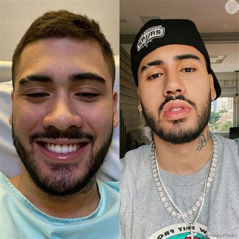 Antes E Depois De Famosos Que Fizeram Rinoplastia Masculina Moda Para Homens