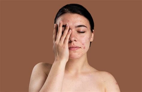 How Do You Get Rid Of Post Inflammatory Hyperpigmentation Trends