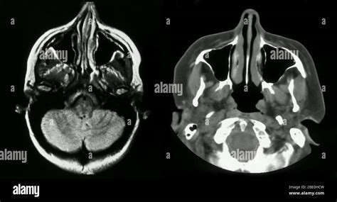 Mris Showing The Normal Brain And Sinuses Stock Photo Alamy