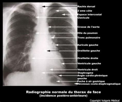 Thorax radio en incidence postéro antérieure Imagerie médicale