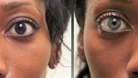Eye Color Change Surgery Before And After