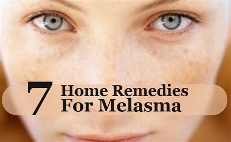 7 Home Remedies For Melasma Morpheme Remedies India