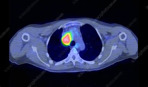 Lymph Node Cancer Ct And Pet Scans Stock Image C0017958 Science