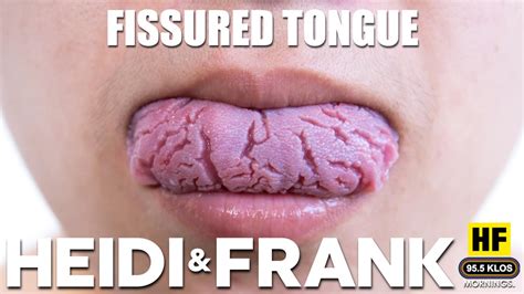 Fissured Tongues Klos Fm