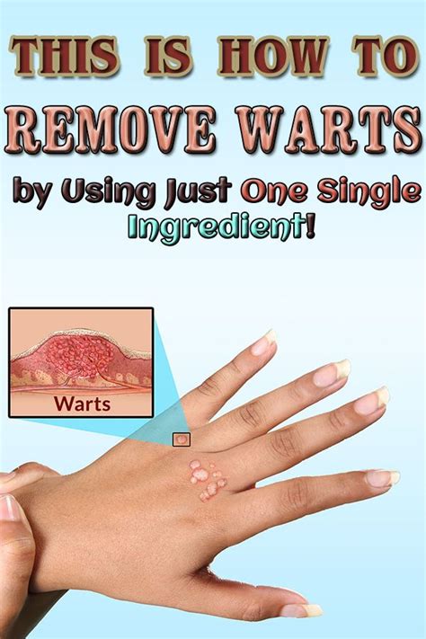 How To Remove Warts By Using Just One Single Ingredient Warts Get