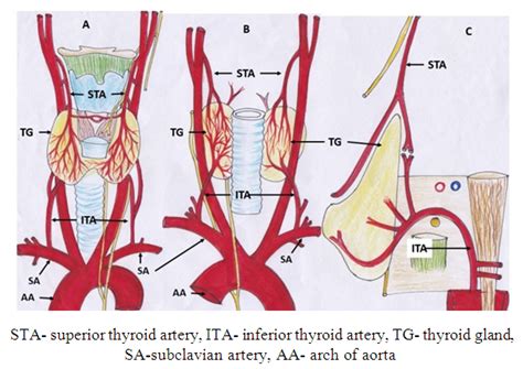 Study Of Thyroidea Ima Artery Narrative Review Of Its Prevalence And Clinical Significance