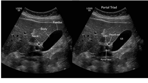 Gallbladder And Biliary Pathology Sonographic Tendencies