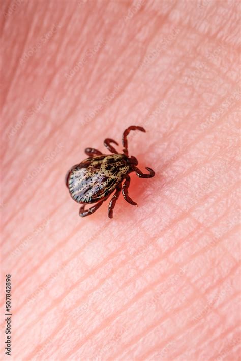 Infectious Encephalitis Tick Insect On Skin Encephalitis Virus Or Lyme