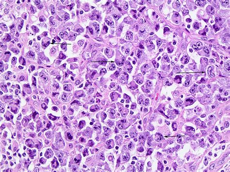 Pathology Outlines Anaplastic Large Cell Lymphoma Alk Positive
