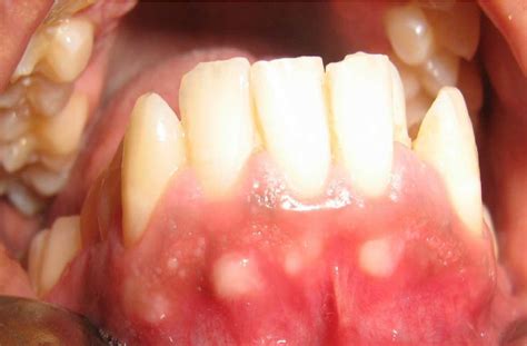 Case 3 Showing Multiple Gfns On The Mandibular Anterior Muco Gingival