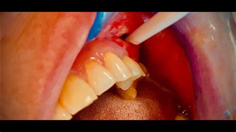 Tooth Abscess Stages Dental Clinic