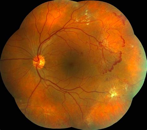 Eye Diseases Retina And Macula Cataract And Glaucoma