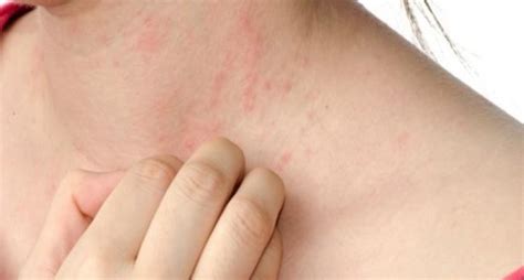 How To Prevent Skin Infections