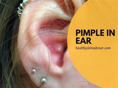 This Your Preferred Guide On How To Get Rid Of A Pimple In Ear Learn