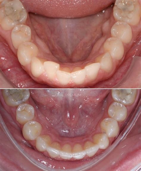 Dentes Alinhados Novamente Com Alinhadores Invis Veis Cl Nica Oral Premium