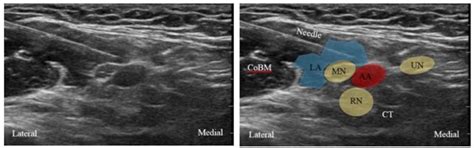 Ultrasound Guided Axillary Brachial Plexus Block Wfsa Resources