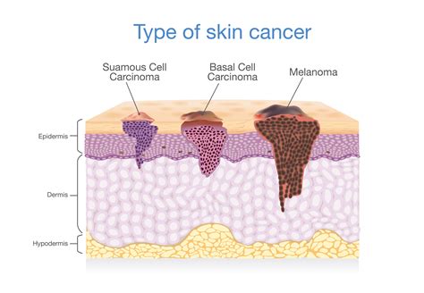 Different Types Of Skin Cancer Treatments