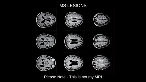 Brain MRI With MS Lesions