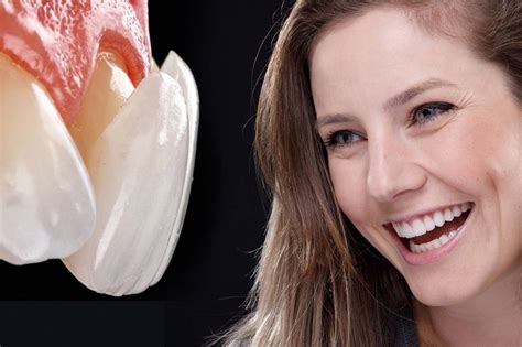 Antes E Depois Da Colocação Das Facetas De Porcelana Clínica Orthos Odontologia Joinville