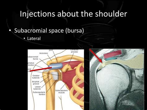 Subacromial Injection