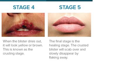 Cold Sore Stages Identification And Treatment