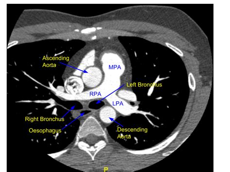 Cardiac Ct Pulmonary Artery Bifurcation All About Cardiovascular System And Disorders