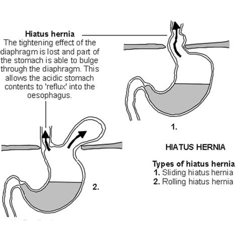 Hernia Surgery Types Paraesophageal Hernia Repair University Of