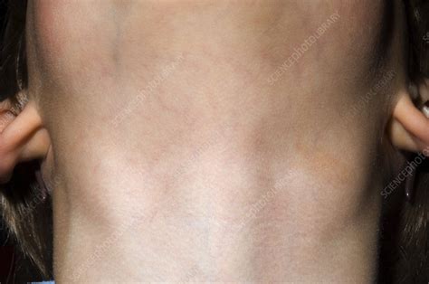 Swollen Lymph Glands In Neck Stock Image M2000250 Science Photo