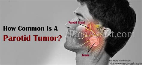Types Of Parotid Gland Tumors