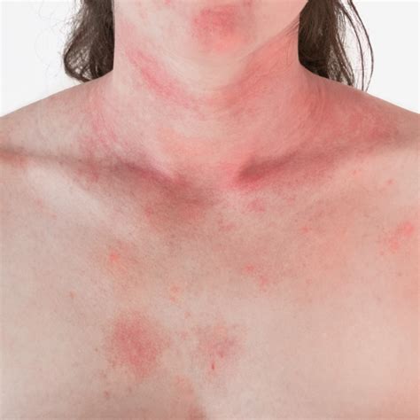 Treatments For Rashes In New York City Park Avenue Skin Care