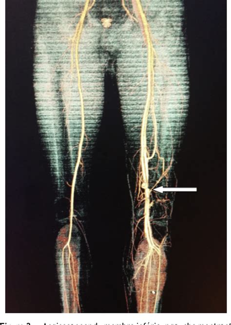 Figure From Post Traumatic Concomitant Popliteal Artery