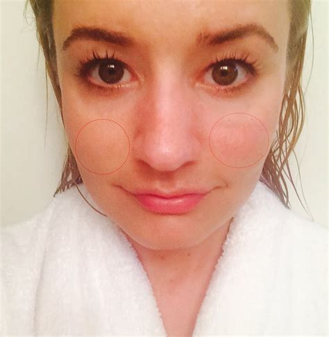 After Shower Selfie Melasma Treatment Popsugar Beauty Photo 2