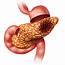 Doctors Discover Why Pancreatic Cancer Kills So Quickly  American