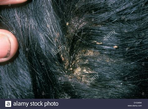 PEDICULOSIS CAPITIS - HEAD LICE INFESTATION Stock Photo ...