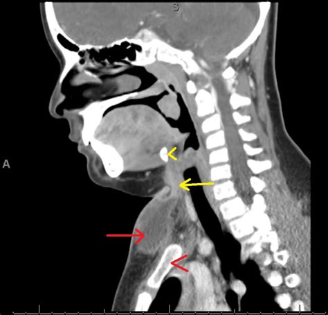 Thyroglossal Duct Cyst Anterior To The Sternum A Novel Presentation Of