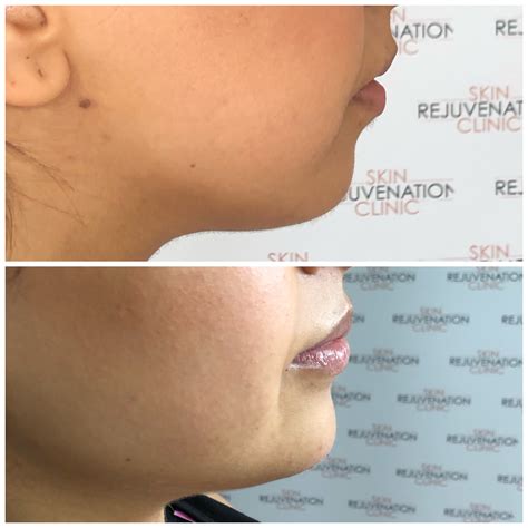 Chin Filler Skin Rejuvenation Clinic