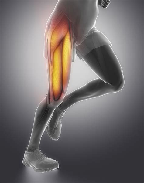 Quadriceps Muscle Tear