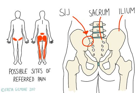 The Sacroiliac Joint SIJ Beth Forrest Osteopathy