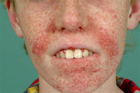Acd A Z Of Skin Tuberous Sclerosis Complex