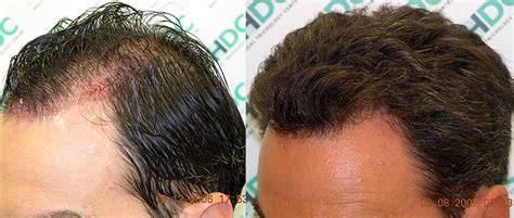 Risks, side effects and interactions. Saw Palmetto Hair Loss Benefits | Get information about ...