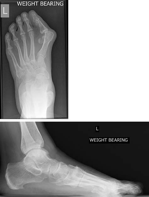 Three Year Follow Up Results Of Combined Short Scarf Osteotomy With