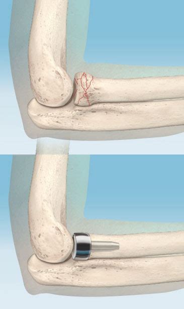 Radial Head Fracture Repair Elbow Fracture Houston Hand Surgeon
