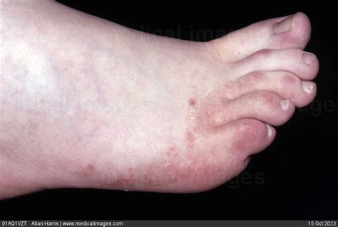 Stock Image Dermatology Tinea Pedis Spreading And Scaling Red Rash